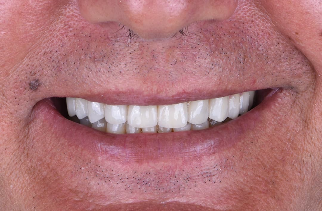 Réhabilitation esthétique complète - après