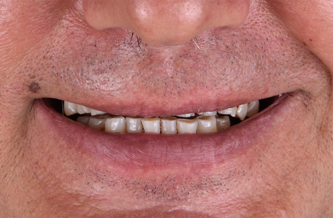 Réhabilitation esthétique complète - avant