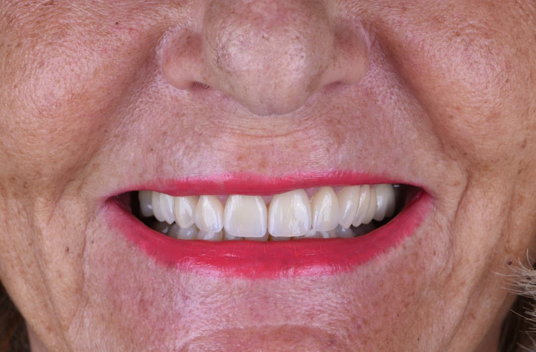 Reconstruction implantaire - après