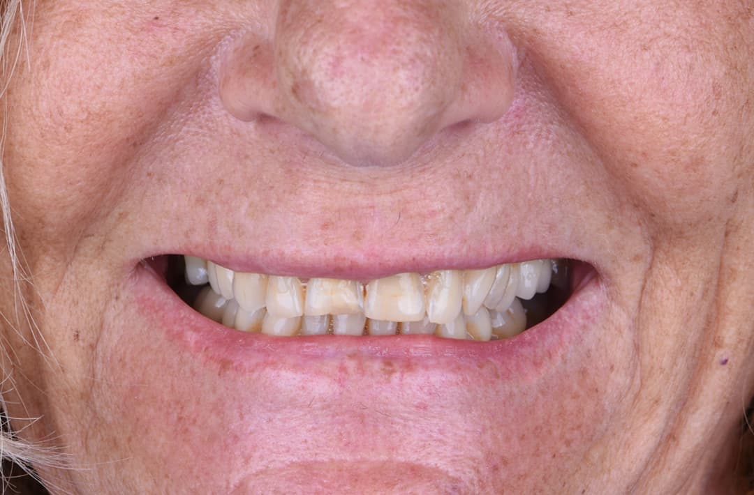 Reconstruction implantaire - avant