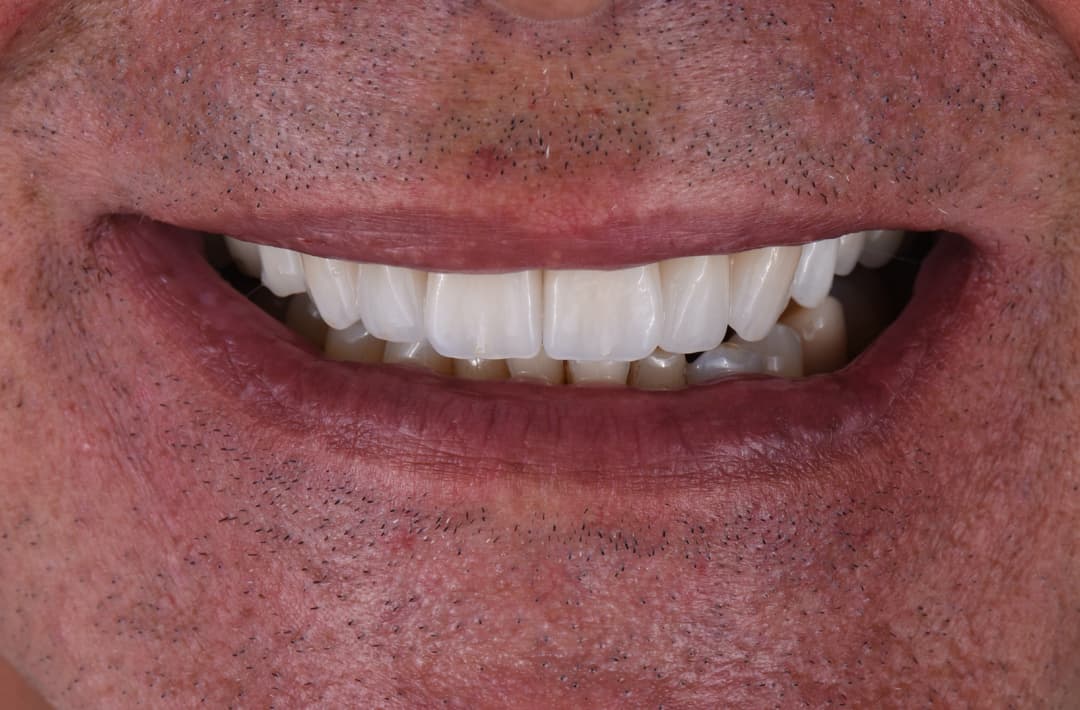 Sauvetage d’une molaire - après