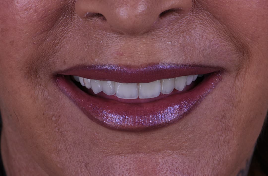 Stabilisation d’une parodontite - après